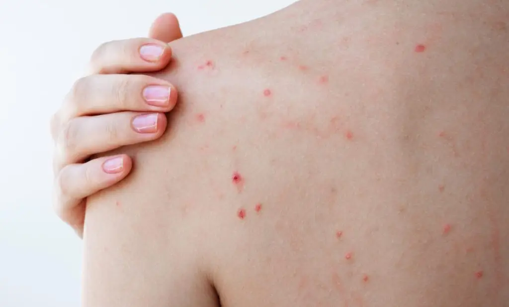 menopausia erupciones piel Flavia