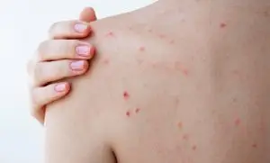menopausia erupciones piel Flavia