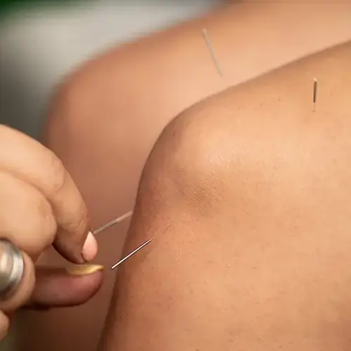 acupuntura